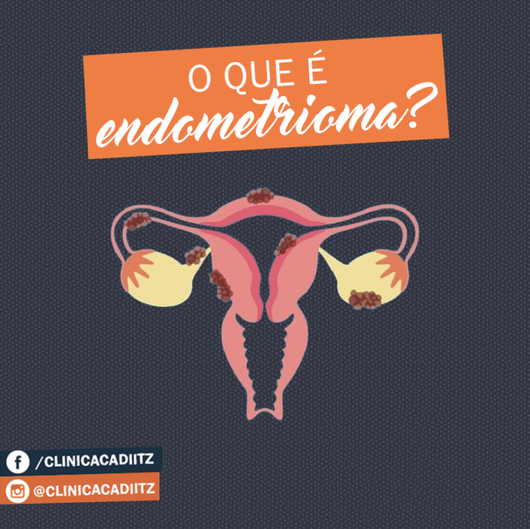 O que é endometrioma? – Clínica CADI